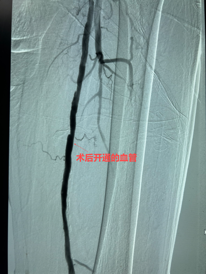 神奇！三甲医院 “无支架化” 手术让血管 “重生”1 (1).png