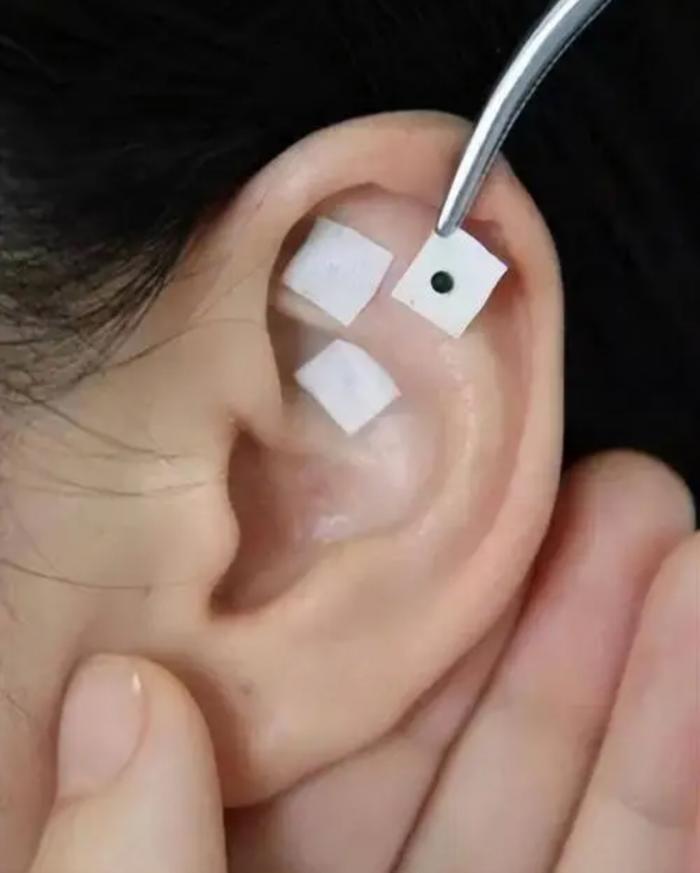 复苏室里的“小秘密”——耳穴疗法1 (3).jpg