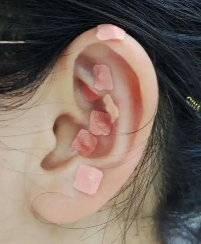 复苏室里的“小秘密”——耳穴疗法1 (1).jpg