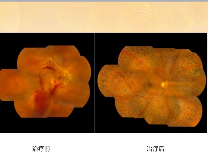 守护“糖友”视界：别让高血糖悄悄偷走视力1 (1).jpg